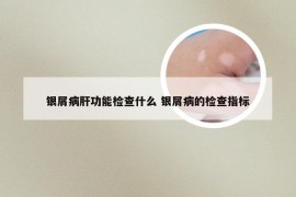 银屑病肝功能检查什么 银屑病的检查指标