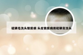 硫磺皂洗头银屑病 头皮银屑病用硫磺膏洗头