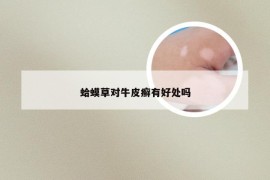 蛤蟆草对牛皮癣有好处吗