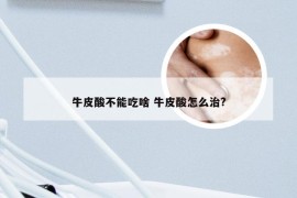 牛皮酸不能吃啥 牛皮酸怎么治?