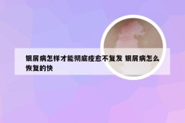 银屑病怎样才能彻底痊愈不复发 银屑病怎么恢复的快