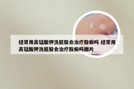 经常用高锰酸钾洗屁股会治疗股癣吗 经常用高锰酸钾洗屁股会治疗股癣吗图片