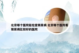 北京哪个医院能检查银屑病 北京哪个医院看银屑病比较好的医院