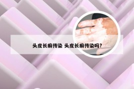 头皮长癣传染 头皮长癣传染吗?