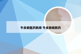 牛皮癣医药新闻 牛皮肤癣新药