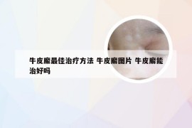 牛皮廨最佳治疗方法 牛皮廨图片 牛皮廨能治好吗