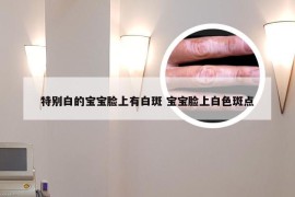特别白的宝宝脸上有白斑 宝宝脸上白色斑点