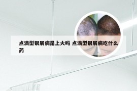 点滴型银屑病是上火吗 点滴型银屑病吃什么药