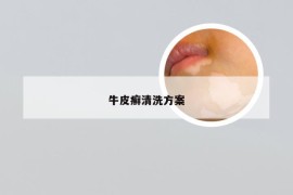 牛皮癣清洗方案