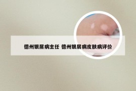 德州银屑病主任 德州银屑病皮肤病评价