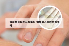 银屑病可以吃马齿菜吗 银屑病人能吃马齿苋吗