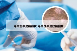 寻常型牛皮癣症状 寻常性牛皮肤癣图片