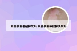 银屑病会引起掉发吗 银屑病会导致掉头发吗