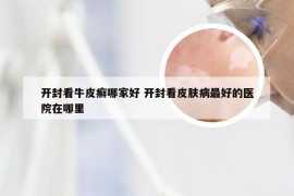 开封看牛皮癣哪家好 开封看皮肤病最好的医院在哪里