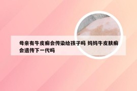 母亲有牛皮癣会传染给孩子吗 妈妈牛皮肤癣会遗传下一代吗