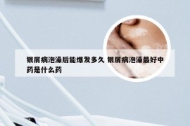 银屑病泡澡后能爆发多久 银屑病泡澡最好中药是什么药