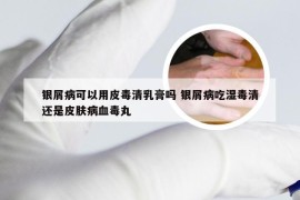银屑病可以用皮毒清乳膏吗 银屑病吃湿毒清还是皮肤病血毒丸