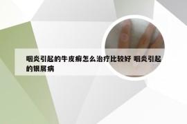 咽炎引起的牛皮癣怎么治疗比较好 咽炎引起的银屑病