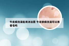 牛皮癣洗澡能用沐浴露 牛皮肤癣洗澡可以用香皂吗