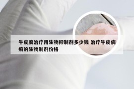牛皮廨治疗用生物抑制剂多少钱 治疗牛皮病癣的生物制剂价格