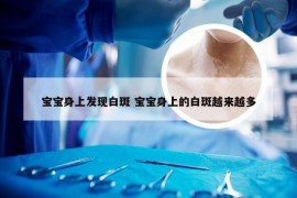 宝宝身上发现白斑 宝宝身上的白斑越来越多