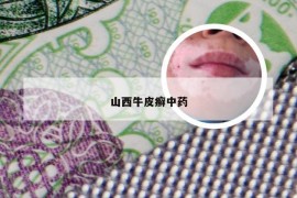 山西牛皮癣中药