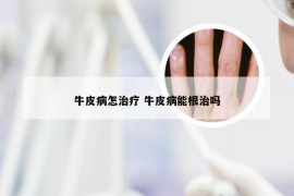 牛皮病怎治疗 牛皮病能根治吗