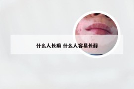 什么人长癣 什么人容易长藓