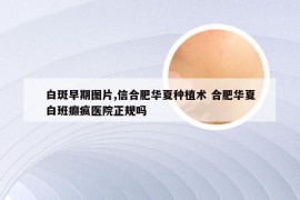 白斑早期图片,信合肥华夏种植术 合肥华夏白班癫疯医院正规吗