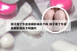 孩子得了牛皮皮癣影响长个吗 孩子得了牛皮皮癣影响长个吗图片