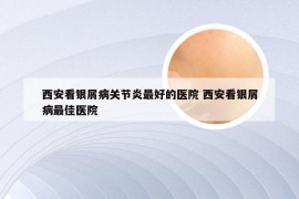西安看银屑病关节炎最好的医院 西安看银屑病最佳医院