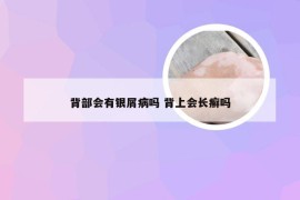 背部会有银屑病吗 背上会长癣吗