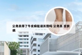 公务员得了牛皮癣能请长假吗 公务员 皮肤病