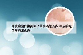 牛皮癣治疗期间喝了羊肉汤怎么办 牛皮癣吃了羊肉怎么办