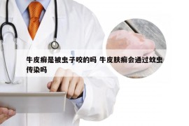 牛皮癣是被虫子咬的吗 牛皮肤癣会通过蚊虫传染吗