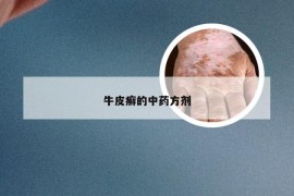 牛皮癣的中药方剂