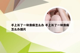 手上长了一块像癣怎么办 手上长了一块像癣怎么办图片