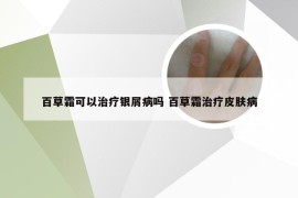 百草霜可以治疗银屑病吗 百草霜治疗皮肤病