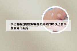 头上有癣过敏性癣用什么药才好呢 头上有头皮癣用什么药