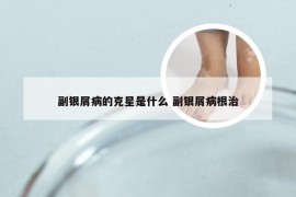 副银屑病的克星是什么 副银屑病根治