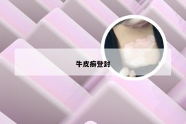 牛皮癣登封