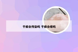 干癣会传染吗 干癣会痒吗