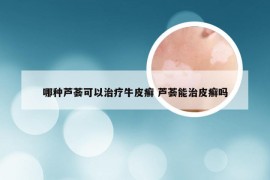 哪种芦荟可以治疗牛皮癣 芦荟能治皮癣吗