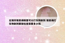 无锡市银屑病哪里可以打生物制剂 银屑病打生物制剂要做检查需要多少钱
