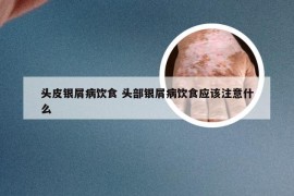 头皮银屑病饮食 头部银屑病饮食应该注意什么