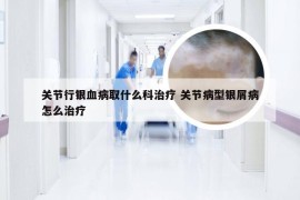 关节行银血病取什么科治疗 关节病型银屑病怎么治疗