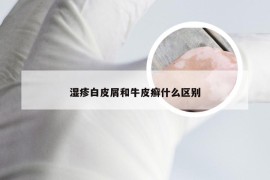 湿疹白皮屑和牛皮癣什么区别