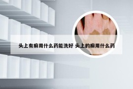 头上有癣用什么药能洗好 头上的癣用什么药