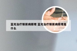 蓝光治疗银屑病原理 蓝光治疗银屑病原理是什么