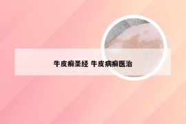 牛皮癣圣经 牛皮病癣医治